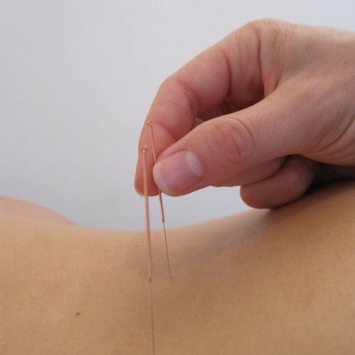 Acupuncture, Lower back pain, rehabilitation